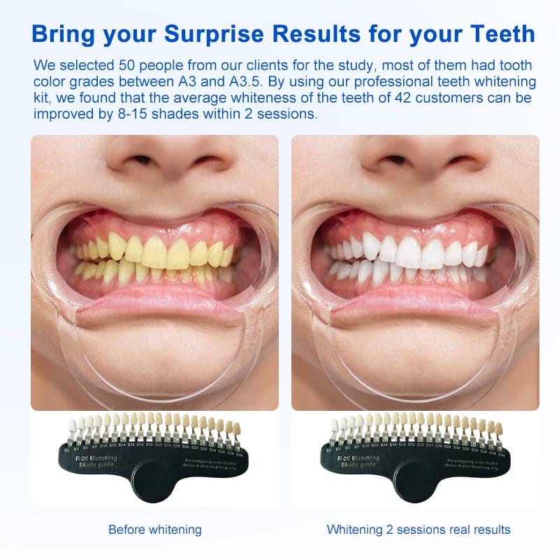 CP Salon Teeth Whitening Kit With Preloaded Mouth Tray