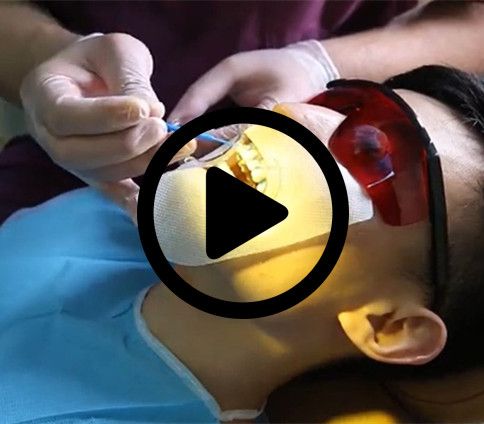 In Office Professional Teeth Whitening Kits